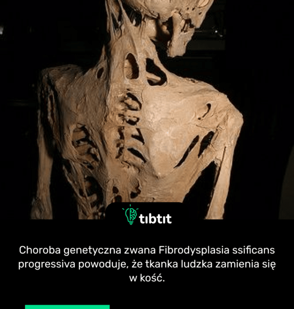 Choroba genetyczna zwana Fibrodysplasia ssificans progressiva powoduje, że tkanka ludzka zamienia się w kość.