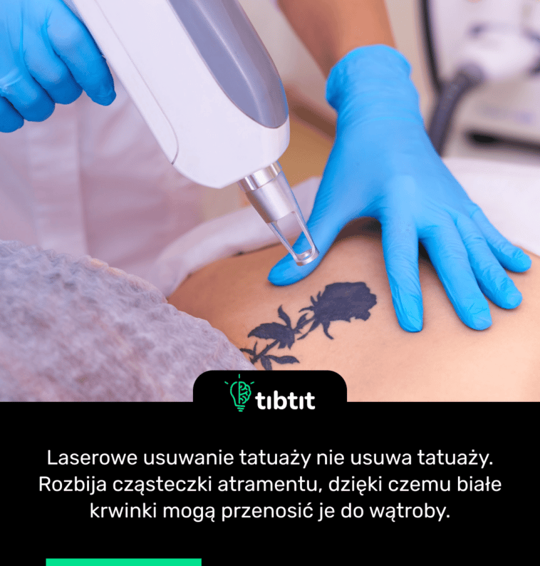 Laserowe usuwanie tatuaży nie usuwa tatuaży. Rozbija cząsteczki atramentu, dzięki czemu białe krwinki mogą przenosić je do wątroby.