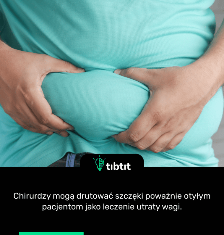Chirurdzy mogą drutować szczęki poważnie otyłym pacjentom jako leczenie utraty wagi.