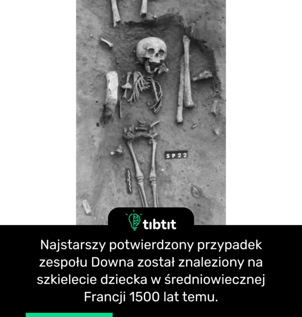 Najstarszy potwierdzony przypadek zespołu Downa został znaleziony na szkielecie dziecka w średniowiecznej Francji 1500 lat temu.