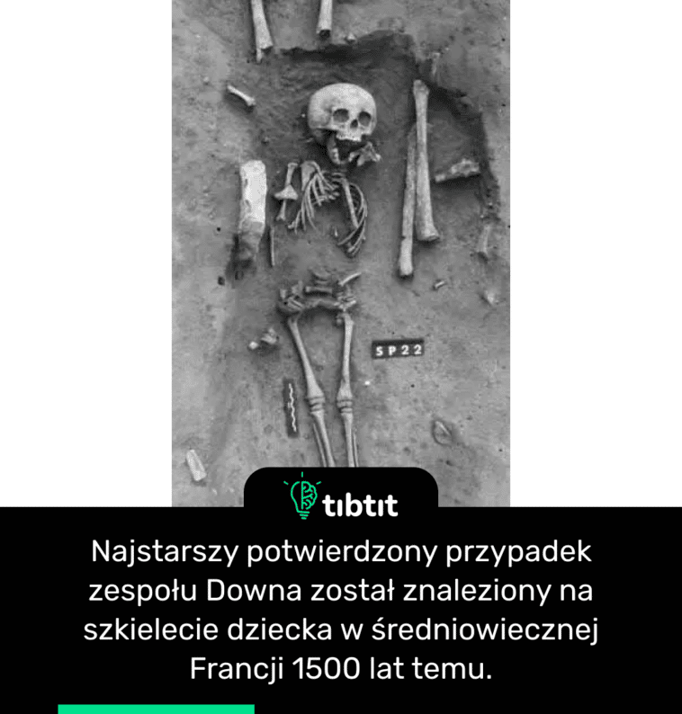 Najstarszy potwierdzony przypadek zespołu Downa został znaleziony na szkielecie dziecka w średniowiecznej Francji 1500 lat temu.