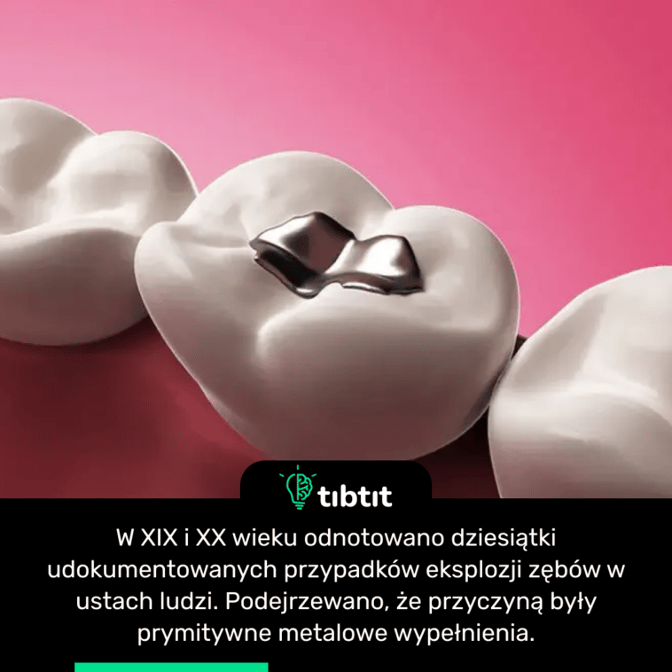 W XIX i XX wieku odnotowano dziesiątki udokumentowanych przypadków eksplozji zębów w ustach ludzi. Podejrzewano, że przyczyną były prymitywne metalowe wypełnienia.