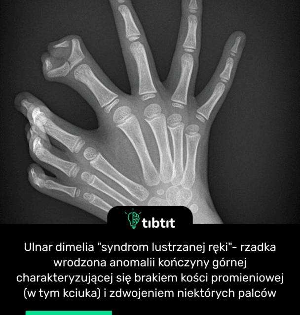 Ulnar dimelia "syndrom lustrzanej ręki"- rzadka wrodzona anomalii kończyny górnej charakteryzującej się brakiem kości promieniowej (w tym kciuka) i zdwojeniem niektórych palców