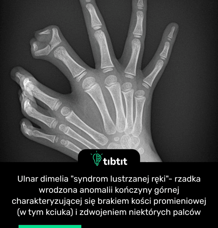 Ulnar dimelia "syndrom lustrzanej ręki"- rzadka wrodzona anomalii kończyny górnej charakteryzującej się brakiem kości promieniowej (w tym kciuka) i zdwojeniem niektórych palców