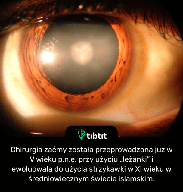 Chirurgia zaćmy została przeprowadzona już w V wieku p.n.e. przy użyciu „leżanki” i ewoluowała do użycia strzykawki w XI wieku w średniowiecznym świecie islamskim.