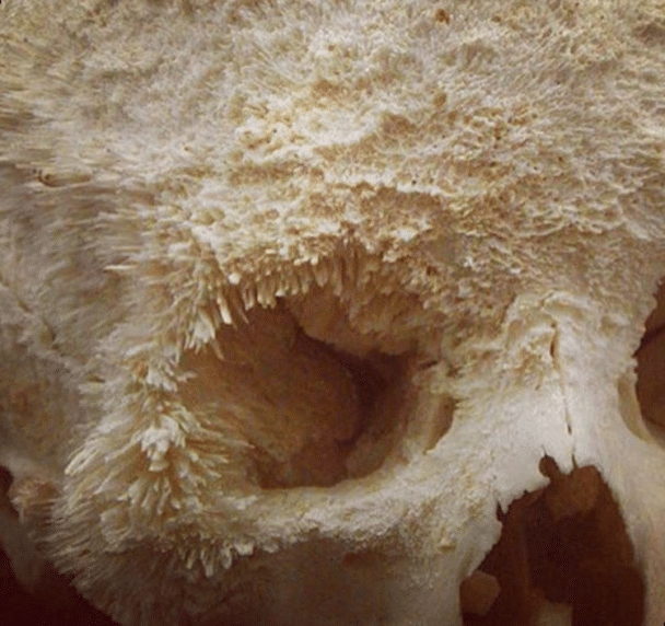 Tak wygląda rak kości