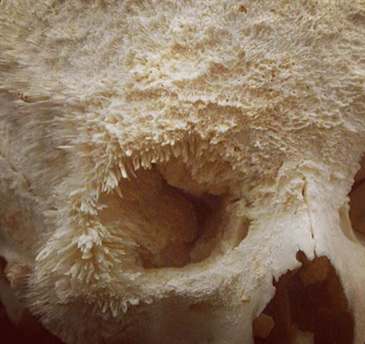 Tak wygląda rak kości