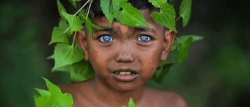 Zespół Waardenburga. Bardzo rzadka choroba genetyczna