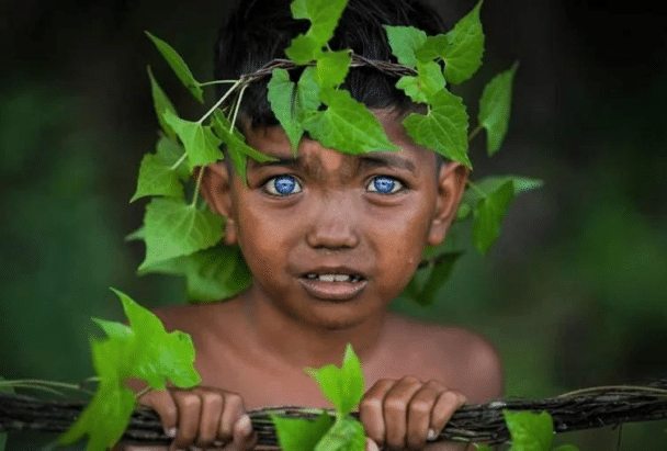 Zespół Waardenburga. Bardzo rzadka choroba genetyczna